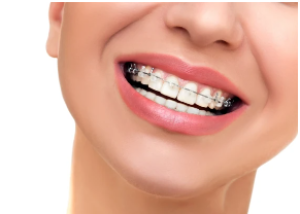 Orthodontie pour adulte - Dr Bellaiche