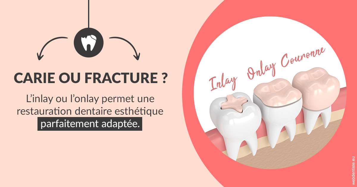 https://dr-bellaiche-jean-marc.chirurgiens-dentistes.fr/T2 2023 - Carie ou fracture 2