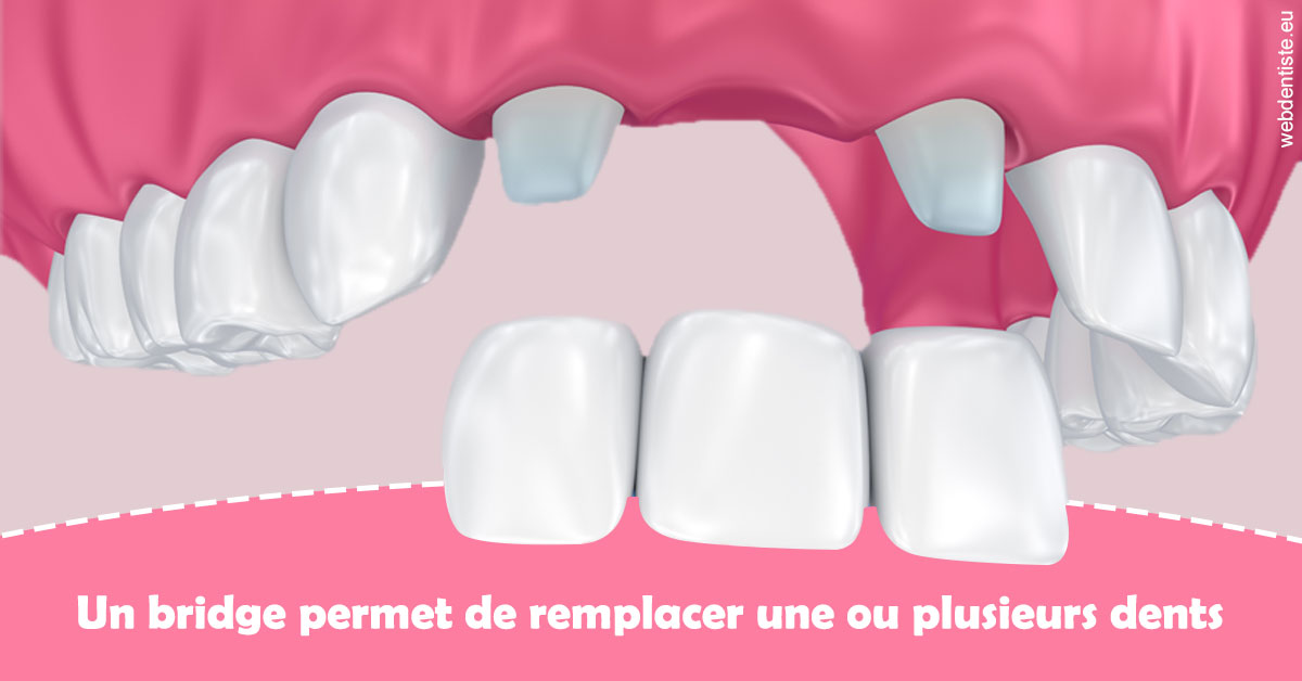https://dr-bellaiche-jean-marc.chirurgiens-dentistes.fr/Bridge remplacer dents 2